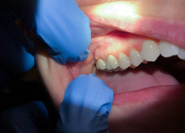 Best Emergency Tooth Extraction in South Jacksonvle, IL