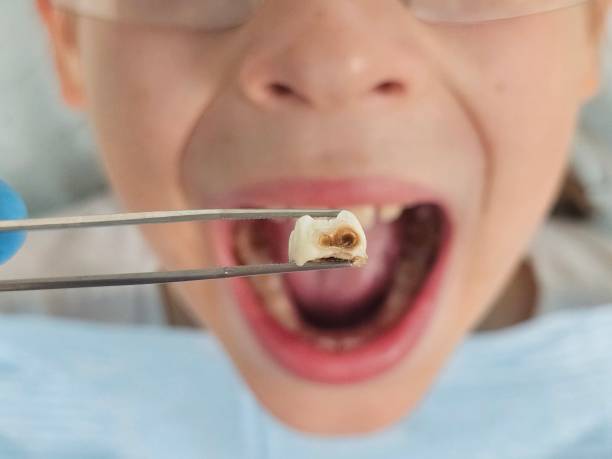 Best Emergency Treatment for Dental Infections or Abscesses in South Jacksonvle, IL